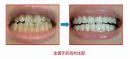 普通烤瓷牙多少钱与烤瓷牙